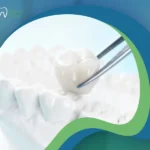 أفضل أنواع الطربوش للأسنان: أيها يناسبك أكثر؟