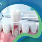 أهمية تركيب الطربوش بعد حشو العصب