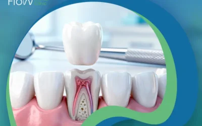 أهمية تركيب الطربوش بعد حشو العصب
