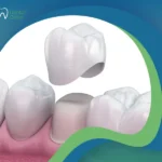 ما هو شكل طربوش الأسنان؟ وكيف يُحدد الشكل المناسب لكل فرد؟