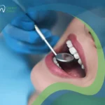 أهم نصائح بعد تبييض الأسنان