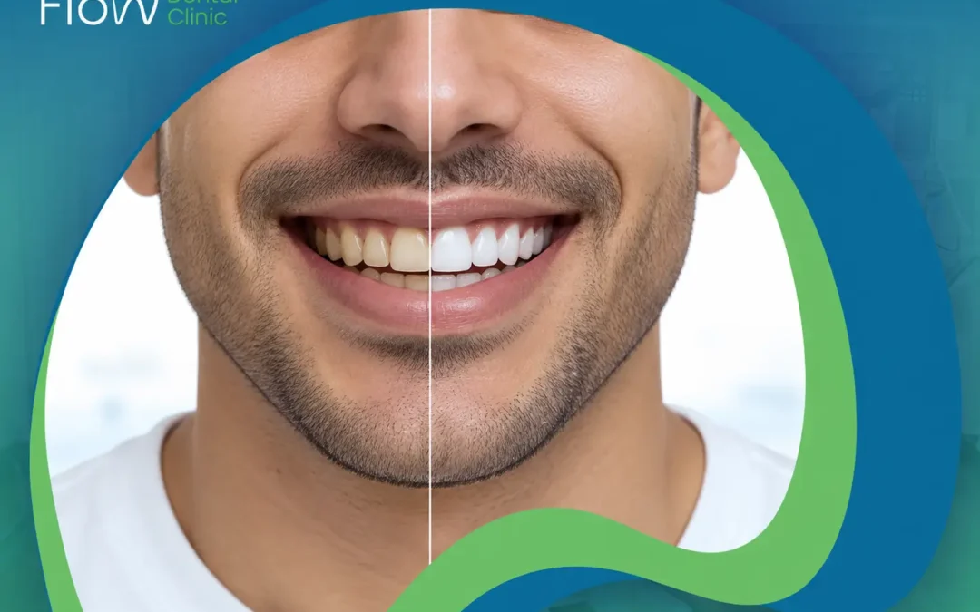 تبييض الأسنان قبل وبعد: دليلك الكامل لنتيجة تستحق الانتظار