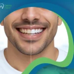 تبييض الأسنان قبل وبعد: دليلك الكامل لنتيجة تستحق الانتظار
